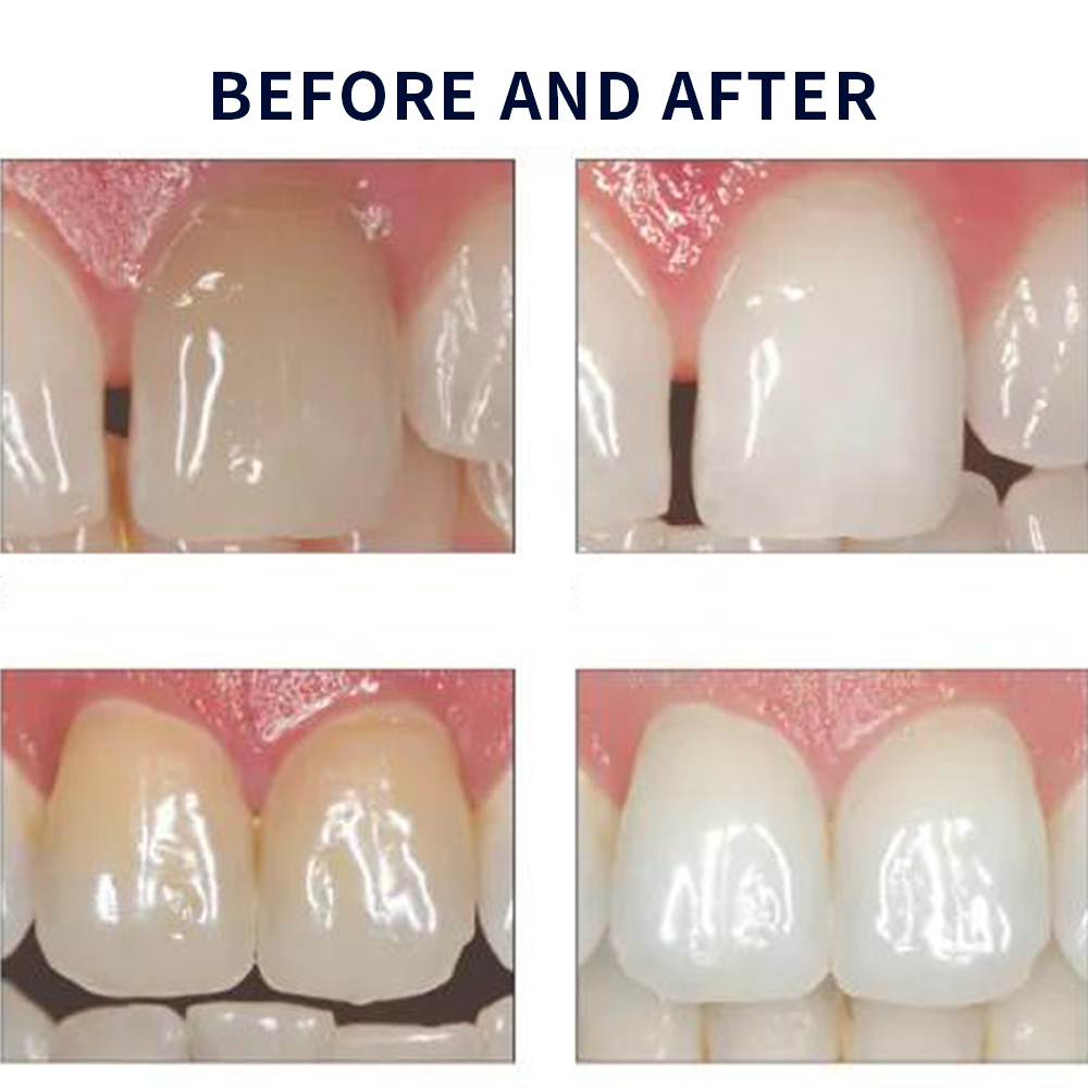 유백광 미백 20% PF 20 16 젤 키트, 초강력  - Teeth Whitening Kit At Home 리뷰 및 가격