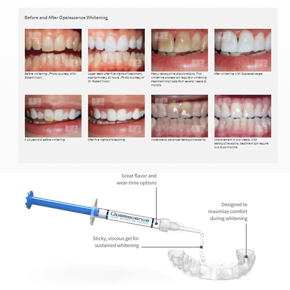유백광 미백 20% PF 20 16 젤 키트, 초강력  - Teeth Whitening Kit At Home 리뷰 및 가격